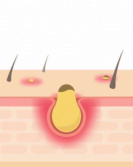 Blackhead Cleanser Water | Remove White & Blackheads